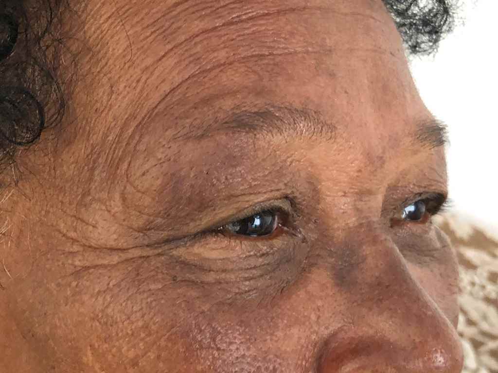 Pacientes realizam cirurgia de pterígio