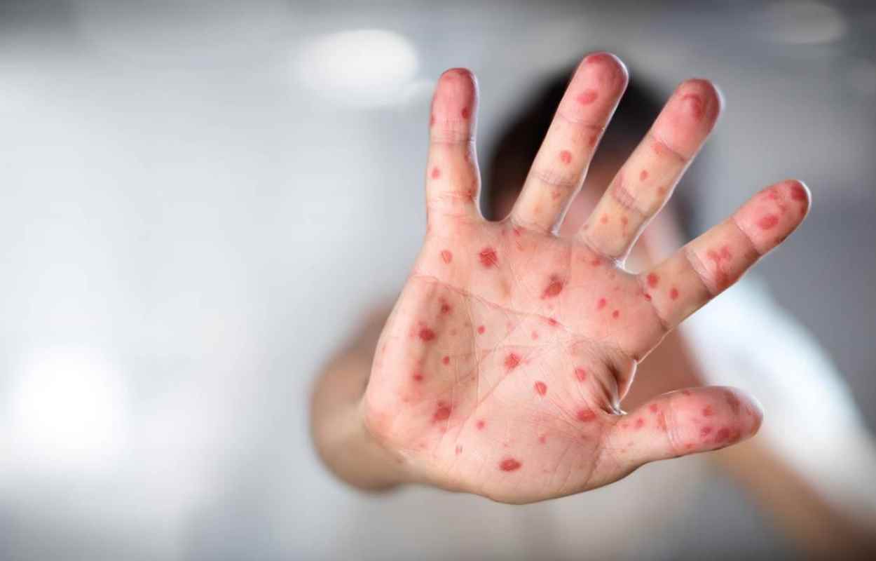 Campanha contra o sarampo prioriza profissionais com maior risco de exposição